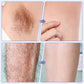 Laser IPL Hair Removal Device With Ice-Cooling Contact